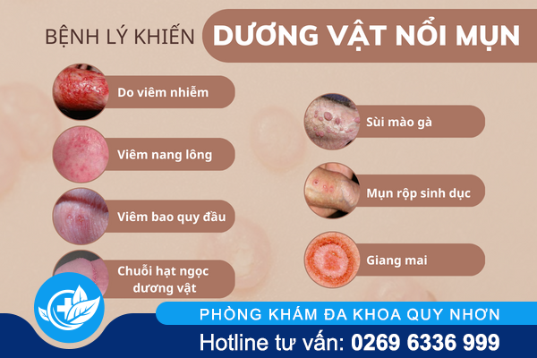 duong-vat-noi-mun-la-do-dau-va-dieu-tri-ra-sao-4