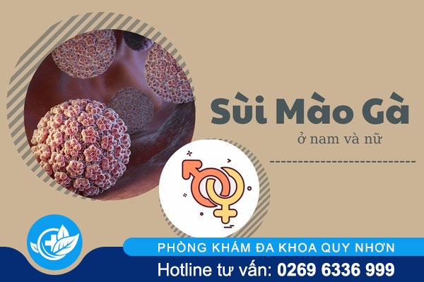 Phân biệt sùi mào gà ở nam và nữ cùng cách điều trị hiệu quả