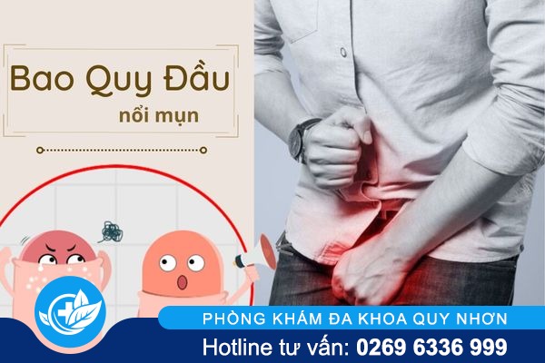 Tại sao bao quy đầu nổi mụn và điều trị thế nào?