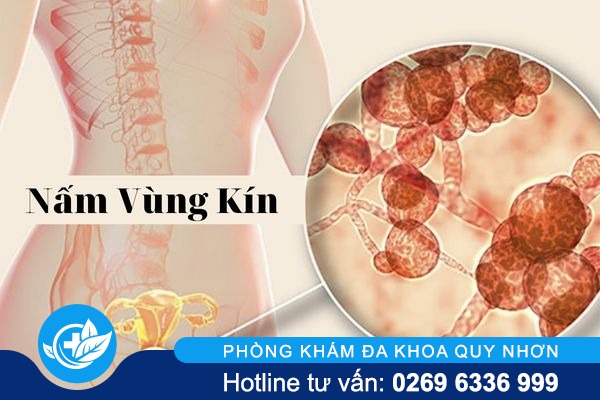 Cảnh báo nấm vùng kín ở nữ giới