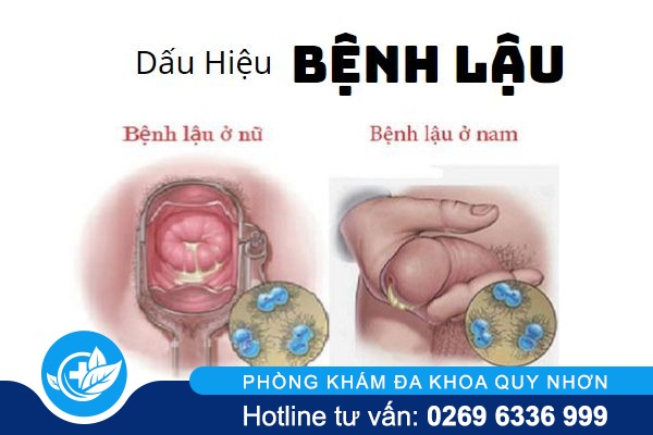 benh-lau-lay-qua-dau-va-con-duong-nao-pho-bien-nhat-1