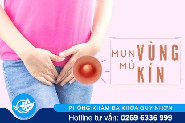 Cảnh báo đừng xem thường mụn mủ vùng kín