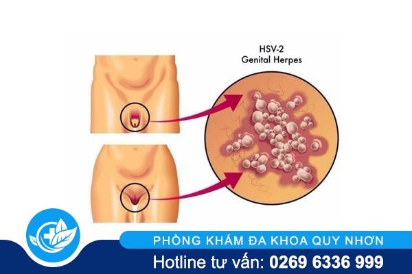 canh-bao-dung-xem-thuong-mun-mu-vung-kin-2