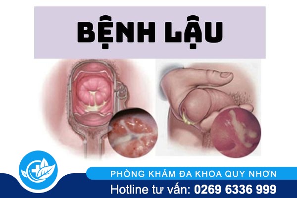 canh-bao-su-nguy-hiem-cua-tinh-trang-tieu-ra-mu-1