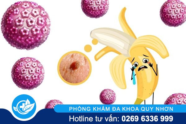 Những thông tin quan trọng về sùi mào gà dương vật 