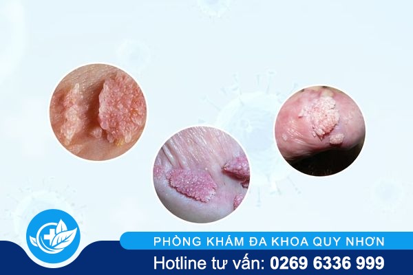 nhung-thong-tin-quan-trong-ve-sui-mao-ga-duong-vat-1