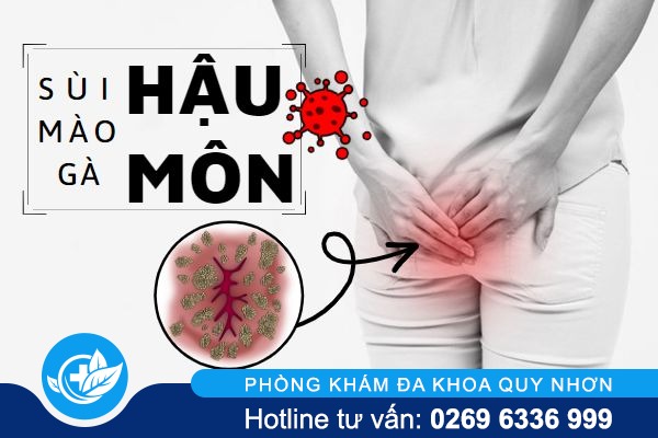 Sùi mào gà hậu môn nguy hiểm khôn lường nhưng ít ai biết