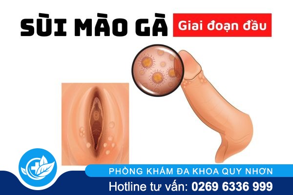 the-nao-la-sui-mao-ga-giai-doan-dau-va-dieu-tri-ra-sao-1