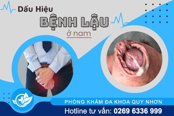 thong-tin-ve-benh-lau-o-nam-va-cach-dieu-tri-toi-uu-nhat-2