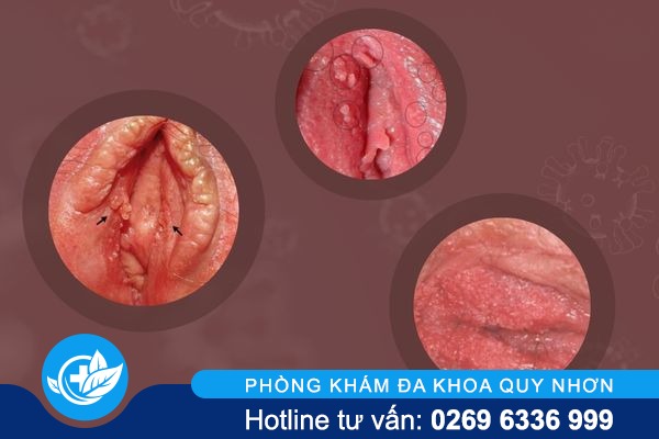 thong-tin-ve-sui-mao-ga-o-moi-lon-va-moi-be-1