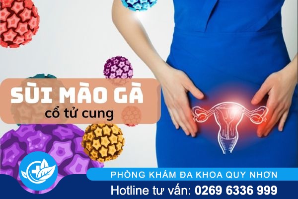 Tổng hợp thông tin về sùi mào gà cổ tử cung 