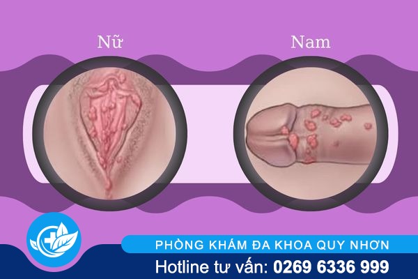 tong-quan-sui-mao-ga-o-nam-va-nu-2