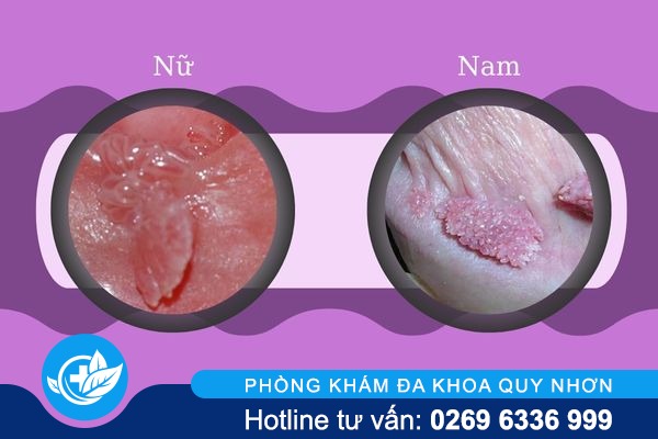 tong-quan-sui-mao-ga-o-nam-va-nu-3