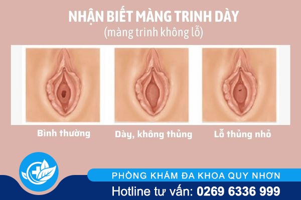 mang-trinh-day-la-gi (2)