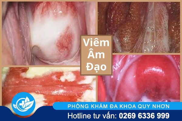 dau-rat-vung-kin-la-benh-gi-va-tri-the-nao-moi-het-1