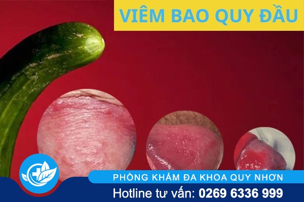 dieu-tri-viem-bao-quy-dau-ngay-truoc-khi-qua-muon-1