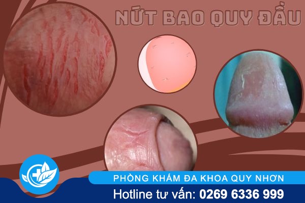 nut-bao-quy-dau-khong-nen-xem-thuong-1