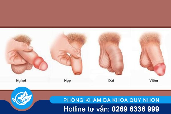 nut-bao-quy-dau-khong-nen-xem-thuong-2