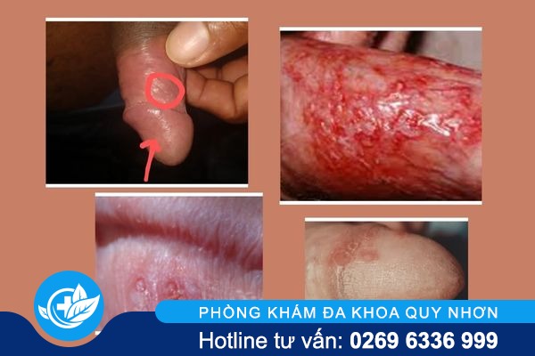 viem-bao-quy-dau-co-tu-khoi-de-nguyen-co-sao-khong-1