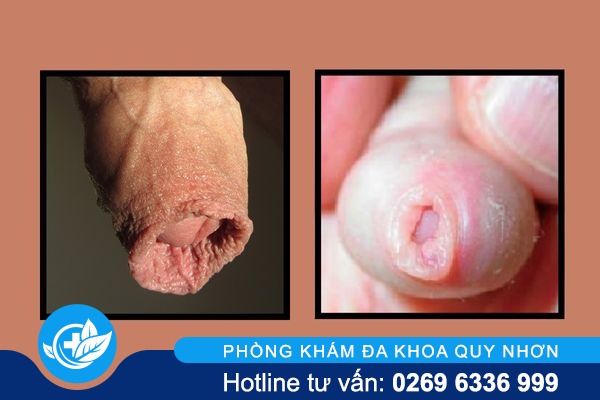 viem-bao-quy-dau-co-tu-khoi-de-nguyen-co-sao-khong-2