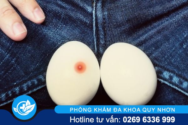 Đừng bỏ qua tình trạng mụn tinh hoàn