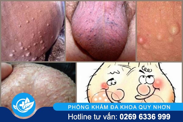 dung-bo-qua-tinh-trang-mun-tinh-hoan-1