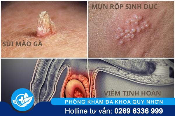 dung-bo-qua-tinh-trang-mun-tinh-hoan-2