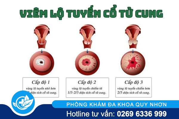 thong-tin-can-biet-ve-benh-viem-lo-tuyen-co-tu-cung-1