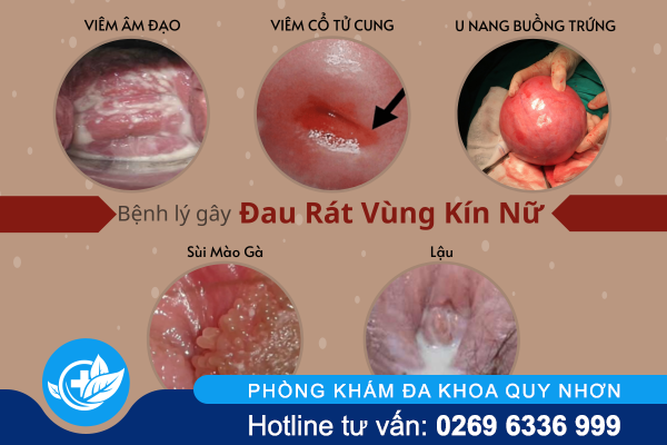 chua-dau-rat-vung-kin-nu-nhu-the-nao-va-o-dau-hieu-qua-1