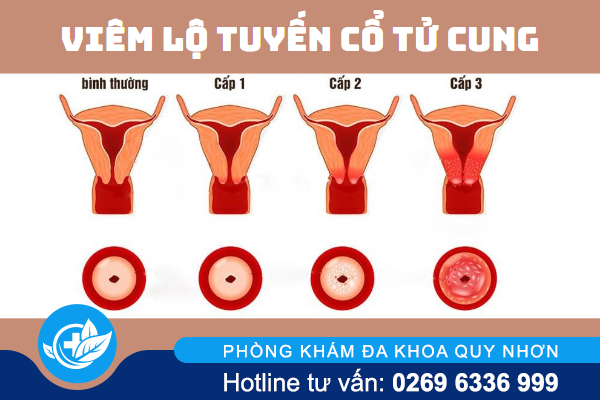 khi-hu-von-cuc-nhu-ba-dau-la-bi-gi-2