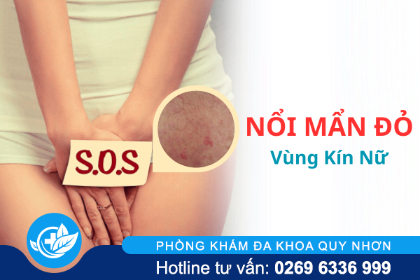 Nguyên nhân và cách trị nổi mẩn đỏ vùng kín nữ