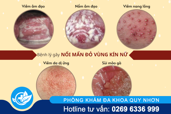 nguyen-nhan-va-cach-tri-noi-man-do-vung-kin-nu-1