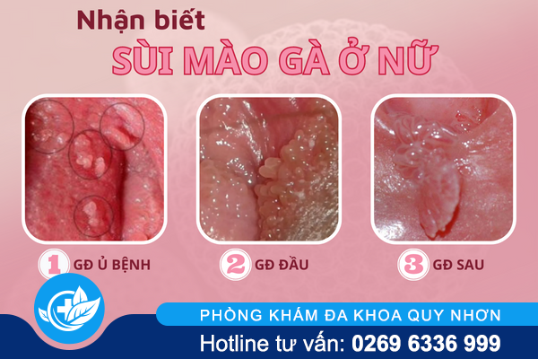 bao-dong-do-ve-sui-mao-ga-o-nu-2