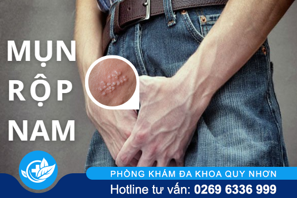 Bệnh mụn rộp nam là gì và chữa trị ra sao?