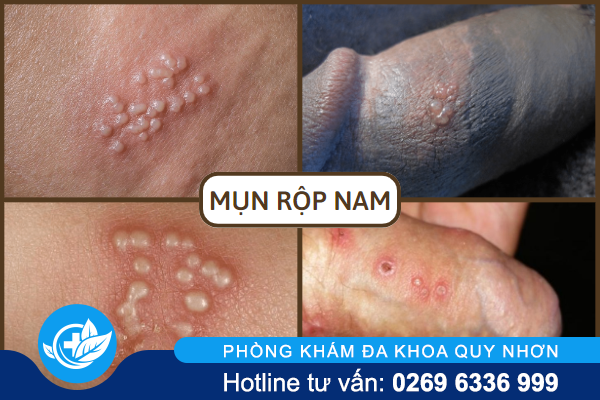 benh-mun-rop-nam-la-gi-va-chua-tri-ra-sao-2