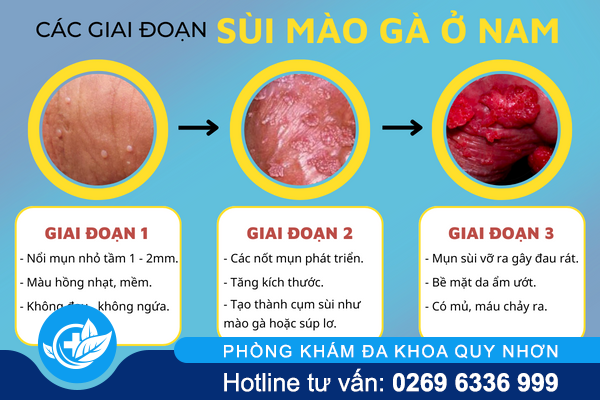 canh-bao-benh-sui-mao-ga-o-nam-gioi-2