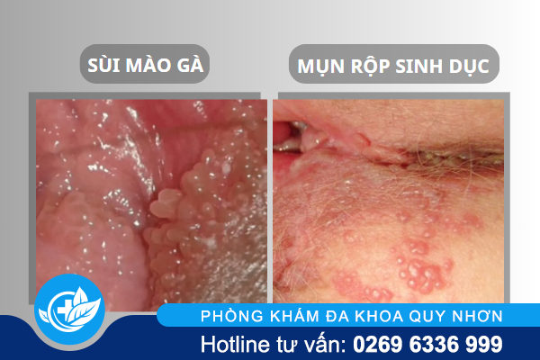 dung-chu-quan-khi-bi-noi-mun-o-am-dao-1