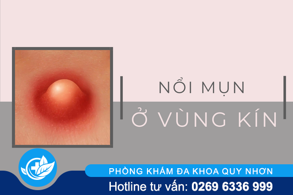 Hết sức cẩn trọng với nổi mụn ở vùng kín