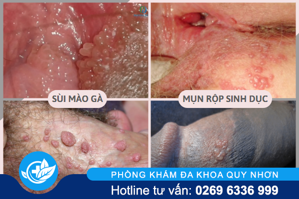 het-suc-can-trong-voi-noi-mun-o-vung-kin-01