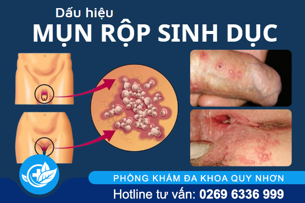 nhan-biet-dau-hieu-mun-rop-sinh-duc-2