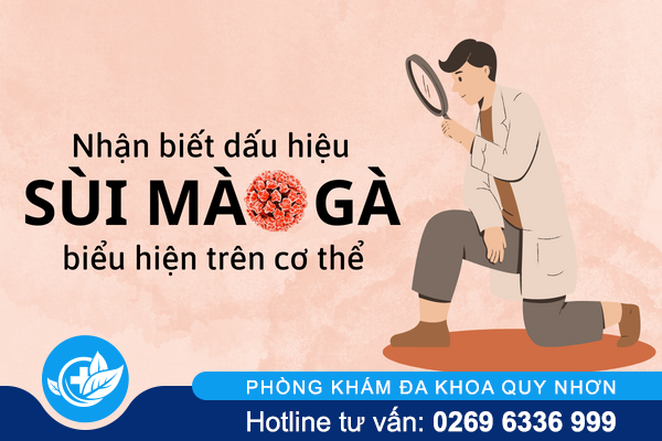 Nhận biết dấu hiệu sùi mào gà biểu hiện trên cơ thể