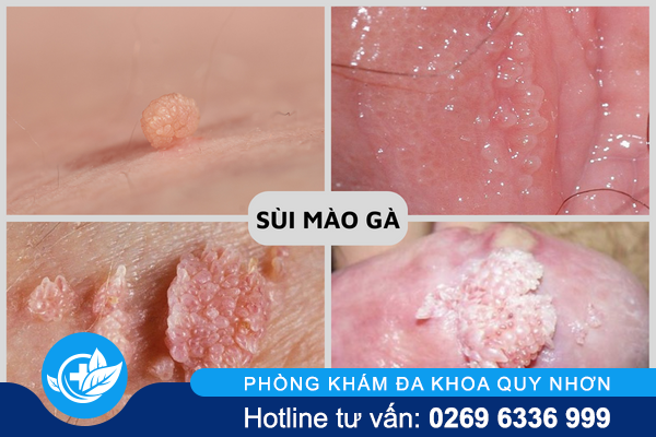 nhung-can-benh-tinh-duc-pho-bien-nhat-hien-nay-1