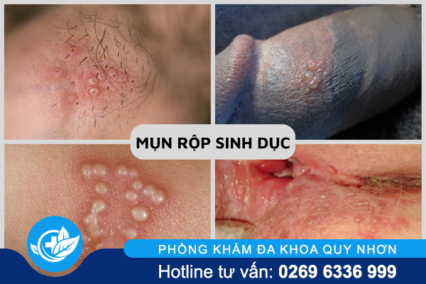 nhung-can-benh-tinh-duc-pho-bien-nhat-hien-nay-2