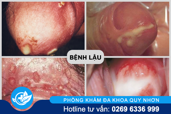 nhung-can-benh-tinh-duc-pho-bien-nhat-hien-nay-3