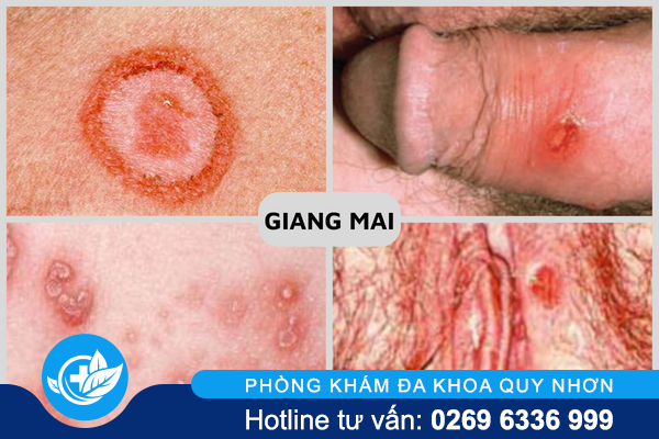 nhung-can-benh-tinh-duc-pho-bien-nhat-hien-nay-4