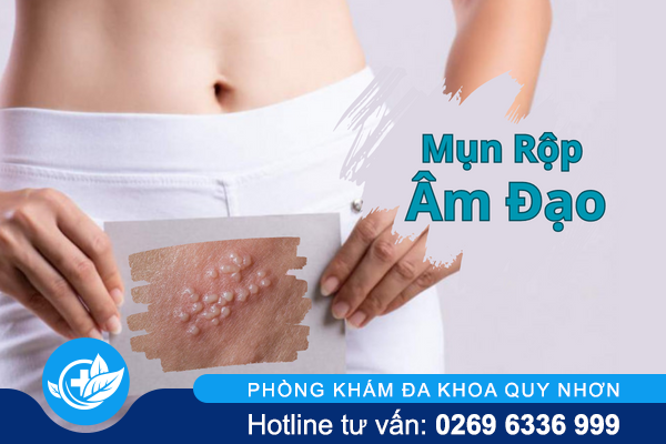 Những điều cần biết về mụn rộp âm đạo