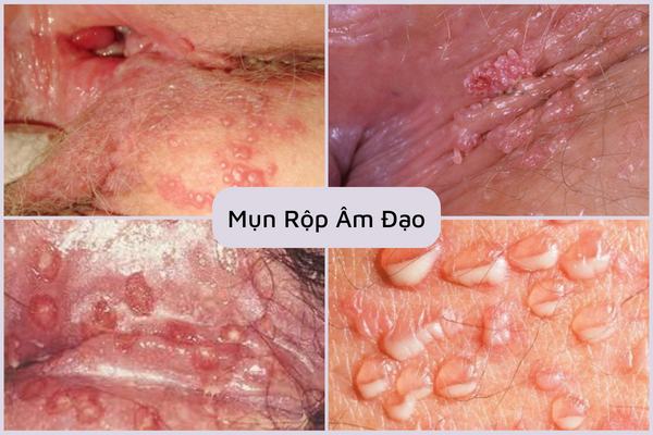 nhung-dieu-can-biet-ve-mun-rop-am-dao-2