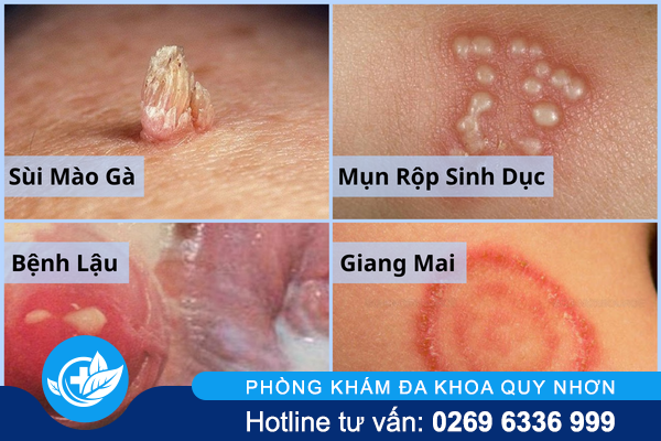 noi-hach-o-vung-kin-la-do-dau-1