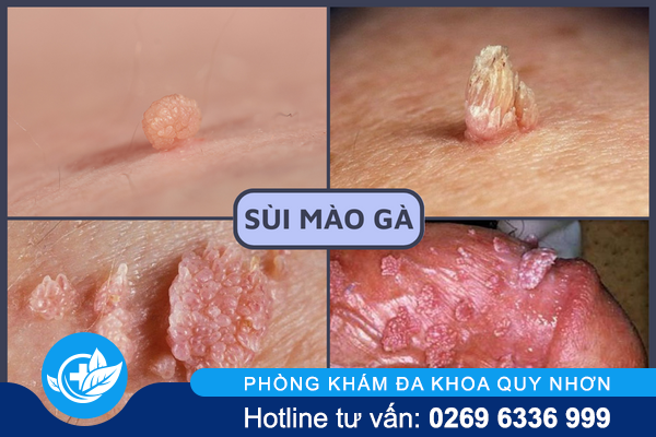 noi-mun-o-duong-vat-la-bi-gi-1