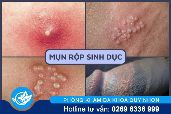 noi-mun-o-duong-vat-la-bi-gi-2